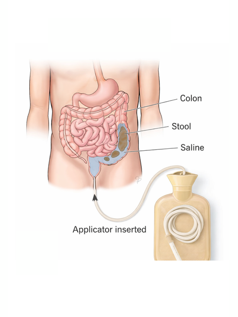 Diagram of a colon with labeled parts and an applicator inserted.